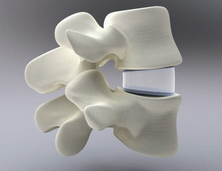Spinal Implant